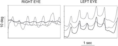 Hypertrophic Olivary Degeneration and Palatal or Oculopalatal Tremor